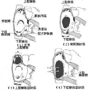 心房間隔缺損