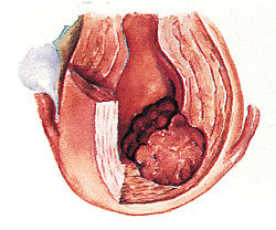 原發性腹膜癌