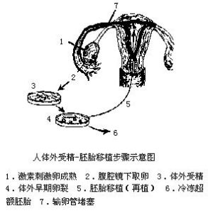 體外受孕