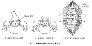 頸椎椎管狹窄