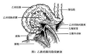 乙狀結腸間疝 圖1