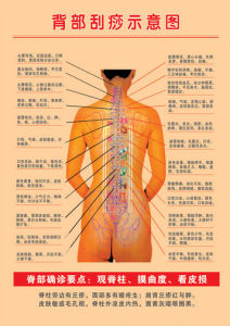 中醫背部刮痧示意圖