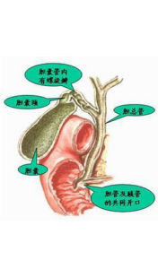 肝門部膽管癌