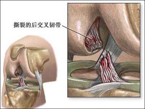（圖）膝外側韌帶損傷