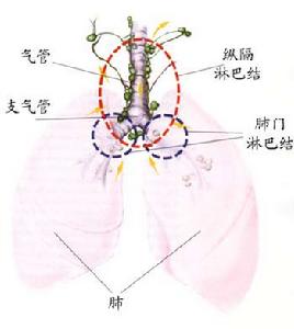 原發性支氣管肺癌