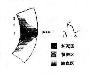 急性心肌梗死