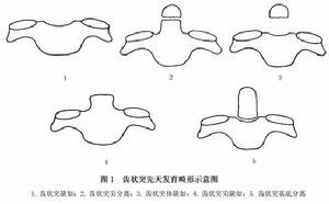 （圖）單純性寰樞椎脫位