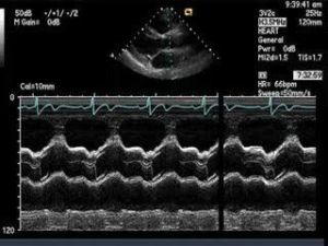 M型超聲心動圖