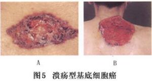 （圖）基底細胞癌