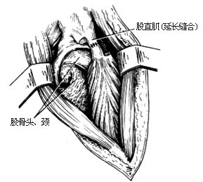 髖關節結核