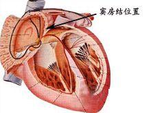 病態竇房結綜合症