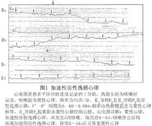 加速性房性逸搏心律