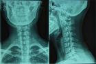 頸椎反弓影像圖