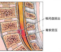 脊椎骨質增生