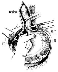 《賁門周圍血管離斷術》