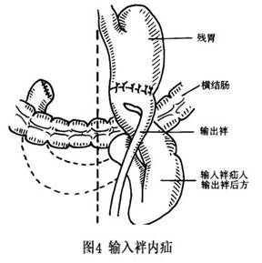 胃切除術後內疝 圖4