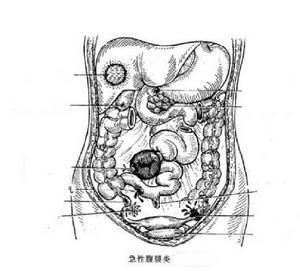 代謝性酸中毒