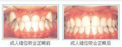 成人正畸對比圖
