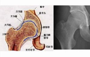 特發性股骨頭壞死