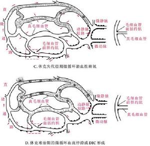 心源性休克