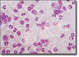 （圖）成人型慢性粒細胞白血病