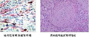 原發性腎小球腎病