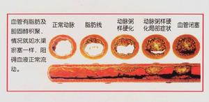 腸系膜動脈粥樣硬化