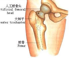 髕骨骨軟骨病