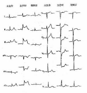 （圖）心肌缺血