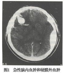 急性腦內血腫