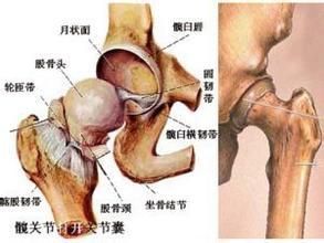 骨壞死