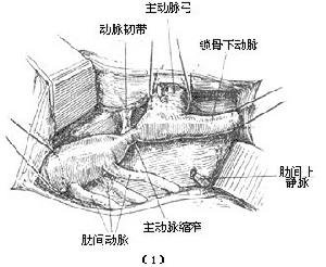 先天性主動脈縮窄