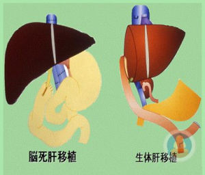 活體肝移植