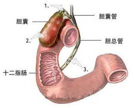 膽囊切除術