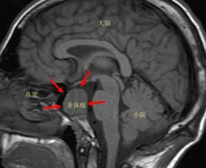 腦垂體微腺瘤