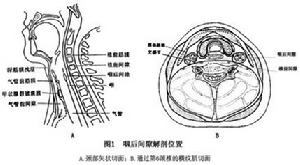 咽後間隙感染