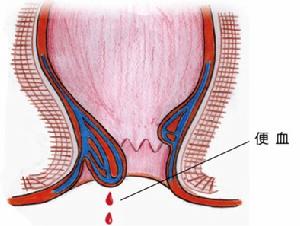 產後便血