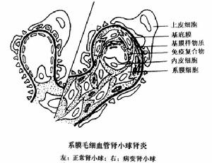 感染性急性小管間質性腎炎