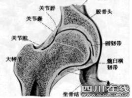 激素型股骨頭壞死