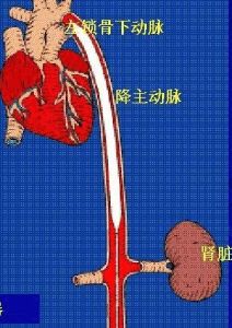 主動脈內球囊反搏