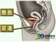 先天性膀胱頸攣縮