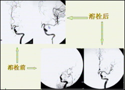 短暫性大腦缺血性發作