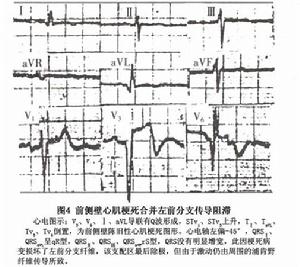 左前分支傳導阻滯