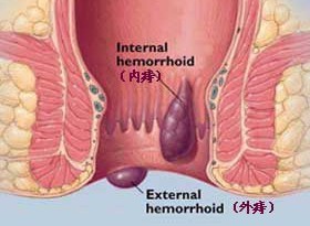 肛瘺便血