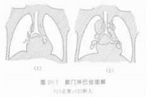 原發性肺結核