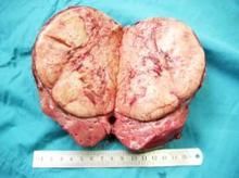 肝細胞瘤
