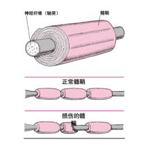 多發性外周神經炎