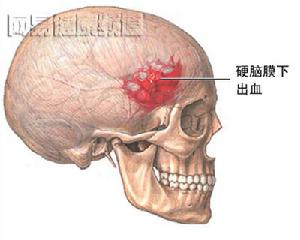 硬腦膜外血腫