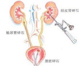 雙腎結石