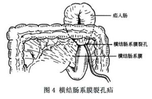 小網膜囊疝 圖4